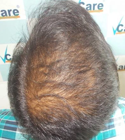 Clinical hair revive therapy before picture in VCare