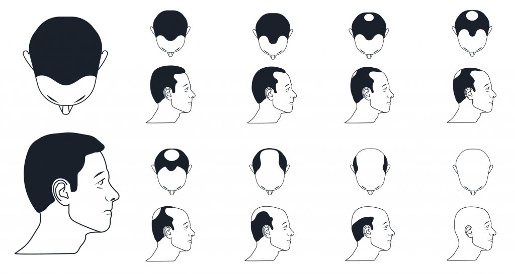 "baldness"