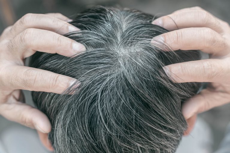 alopecia areata hair loss patches