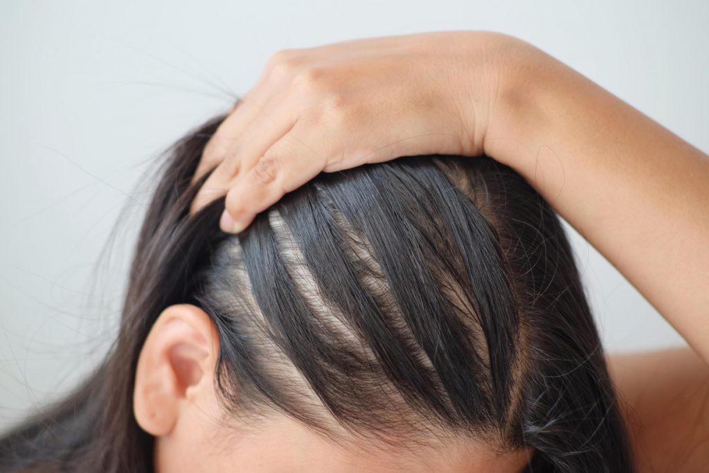 Hair Thinning