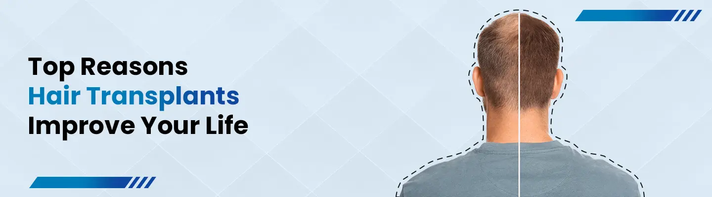Hair Transplantation