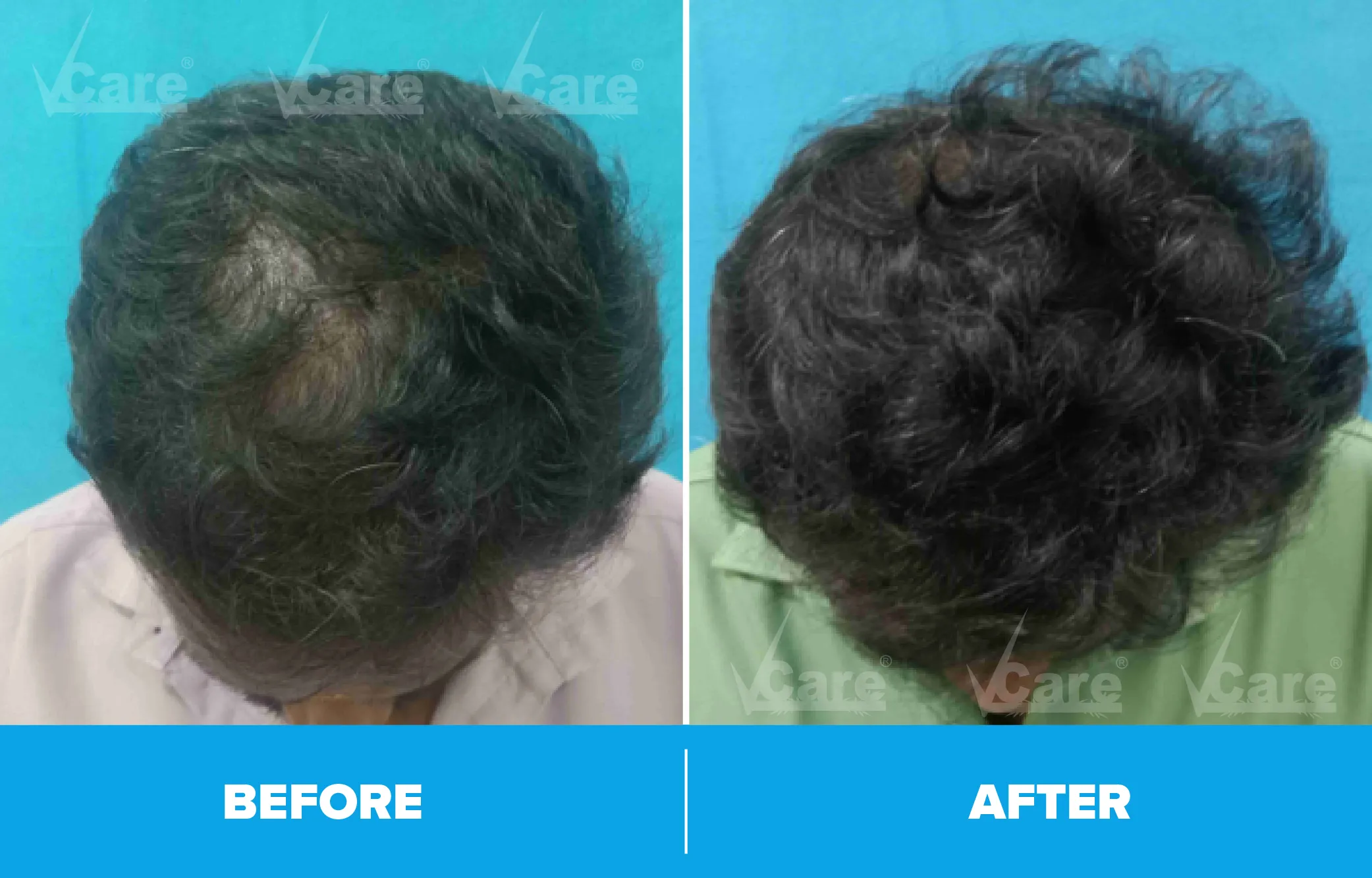Visible hair regrowth results