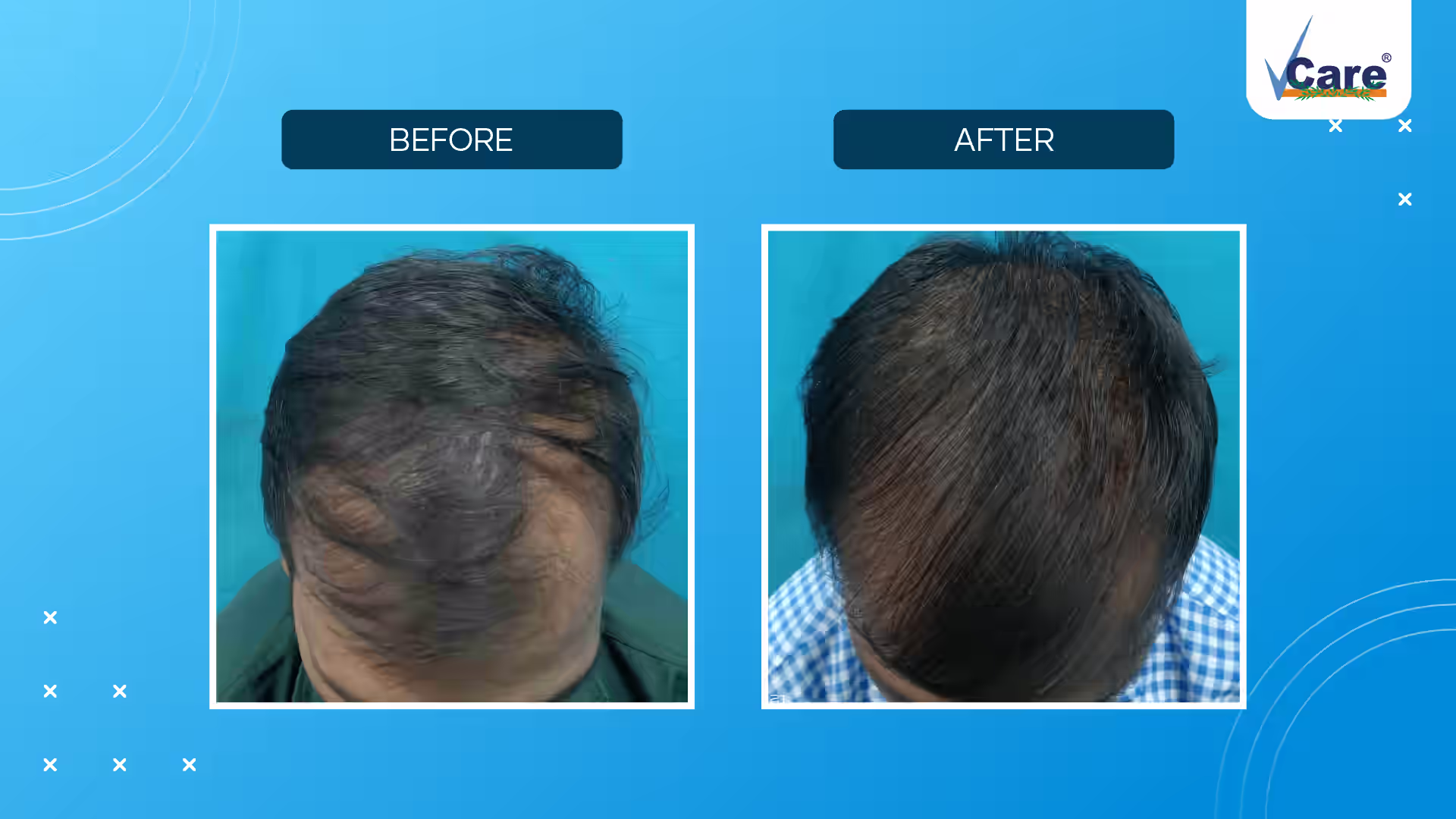 Biocell Hair Growth Therapy Before after result