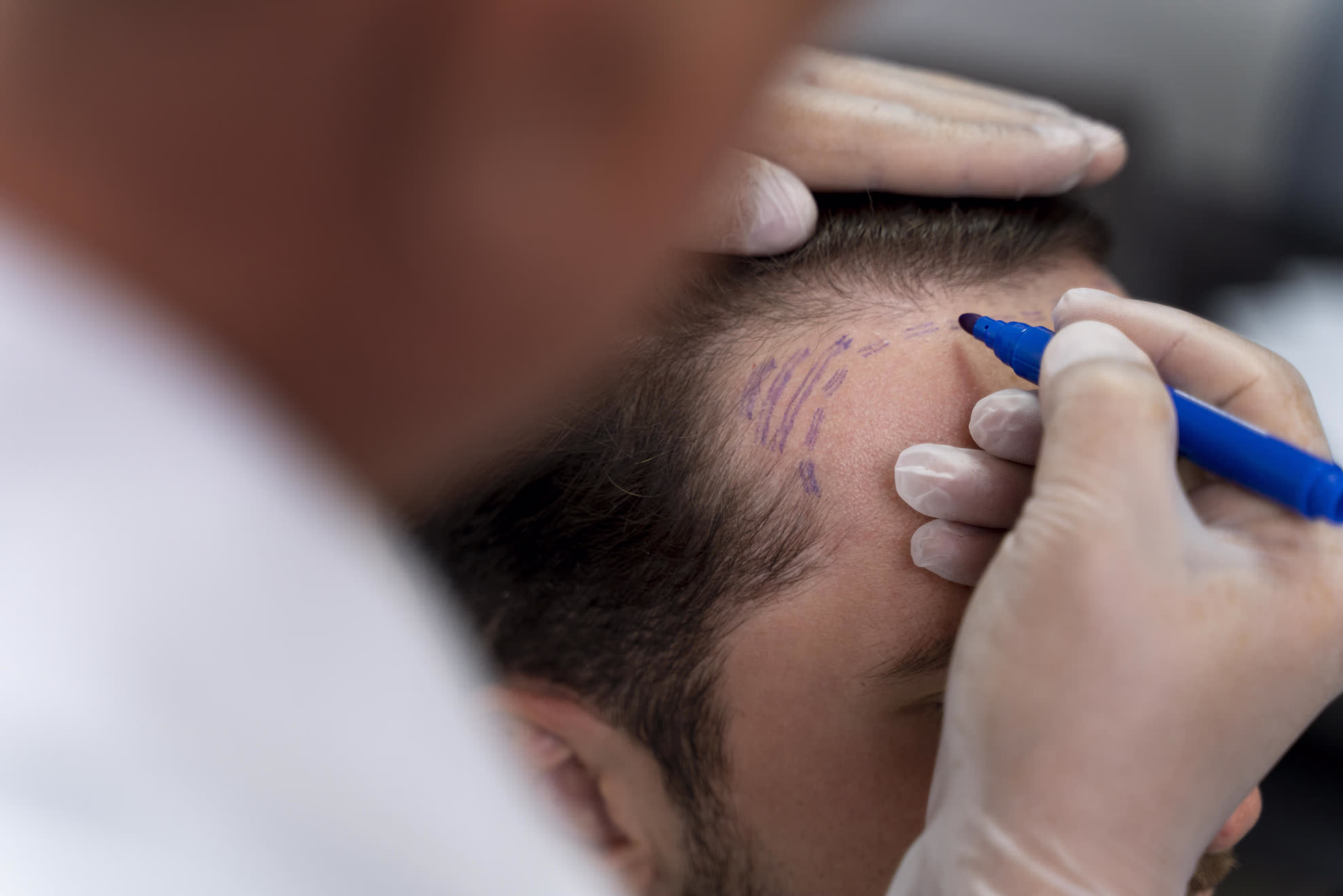 Top Hair Regrowth Treatments To Stop Hair fall: Stem Gen PRP, GFC, ExoGro, & More Top Hair Regrowth Treatments To Stop Hair fall: Stem Gen PRP, GFC, ExoGro, & More