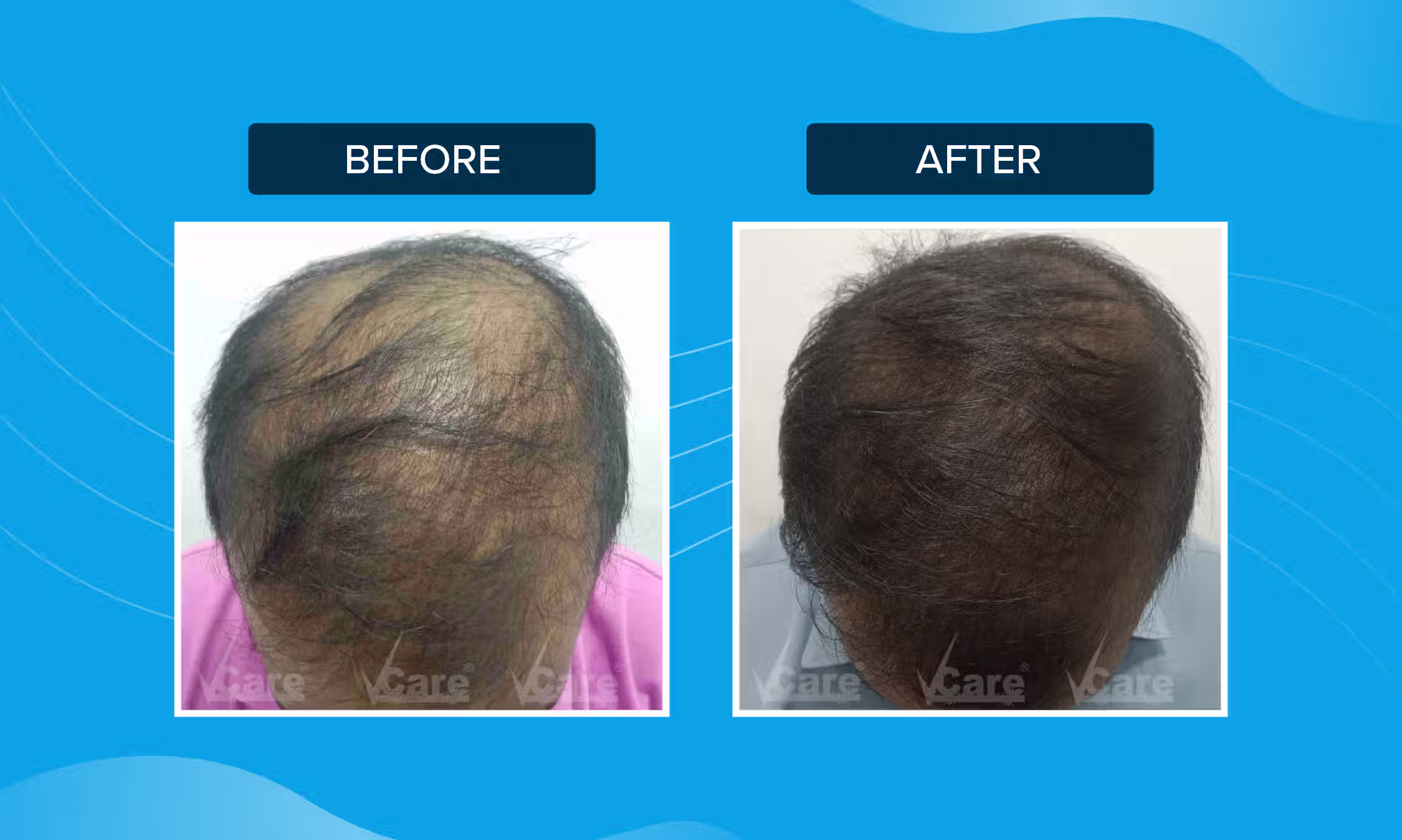 PRP Hair Treatment Before and After