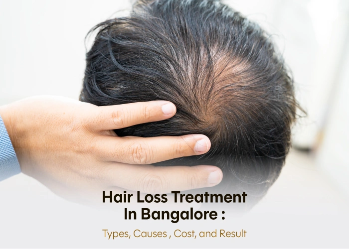 hair loss treatment cost in bangalore
