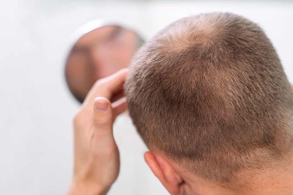 Hair loss treatment

