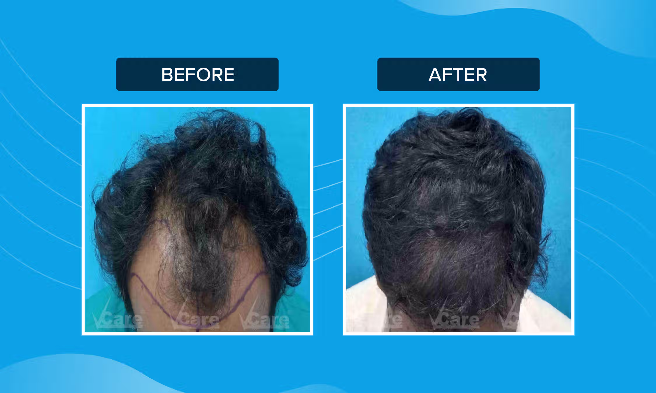 Hair Transplant Result Before and After