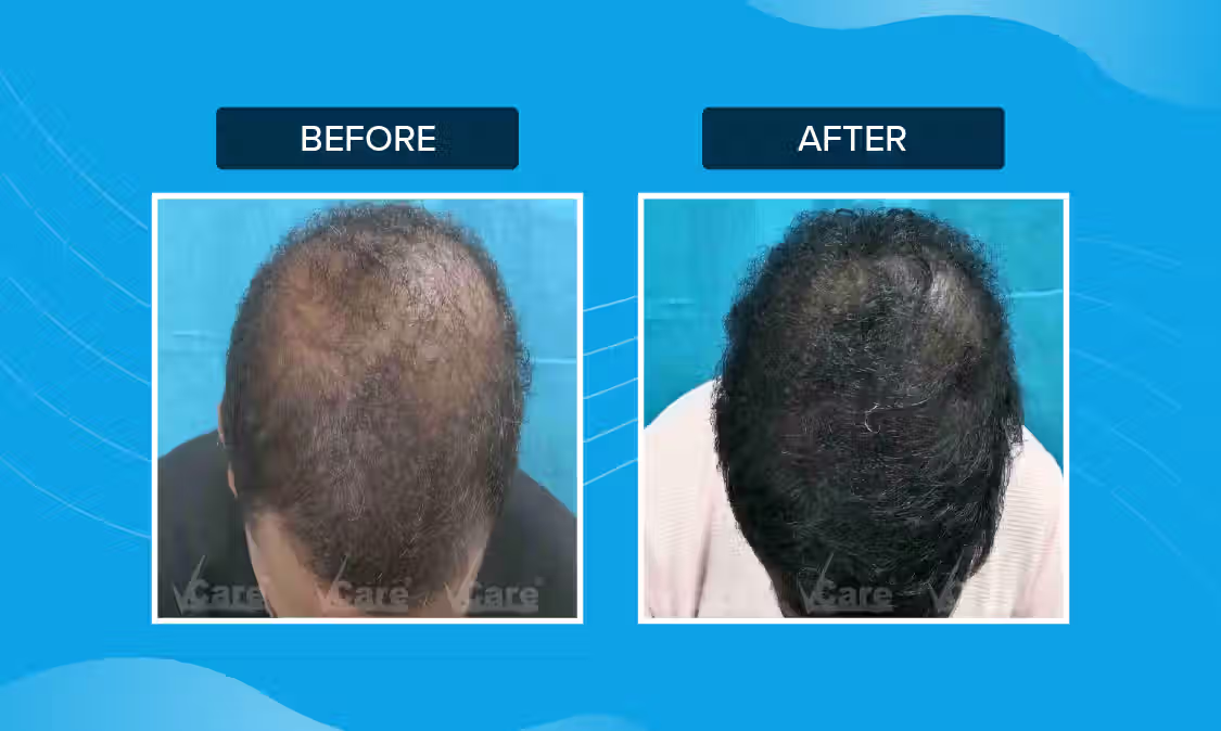 Hair Growth Treatment Result - Before and After