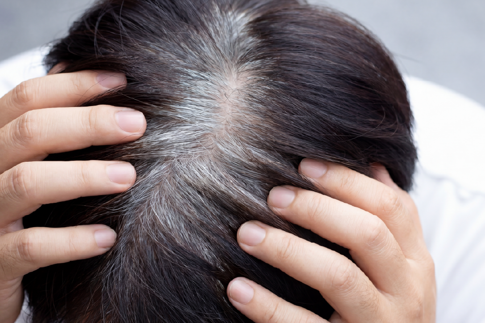 alopecia areata hair loss patches