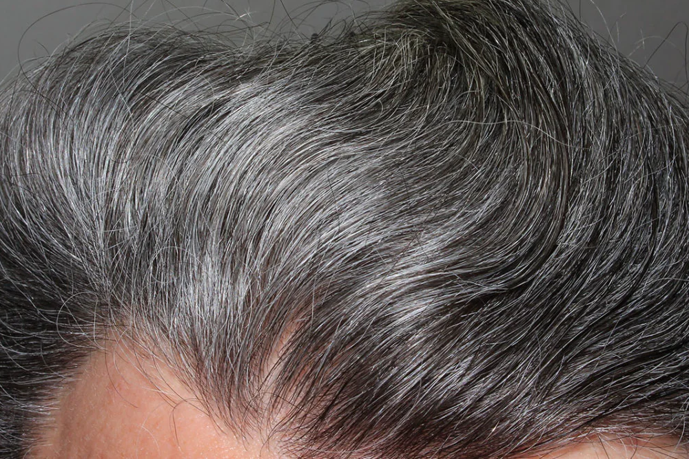 Premature grey hair treatment 