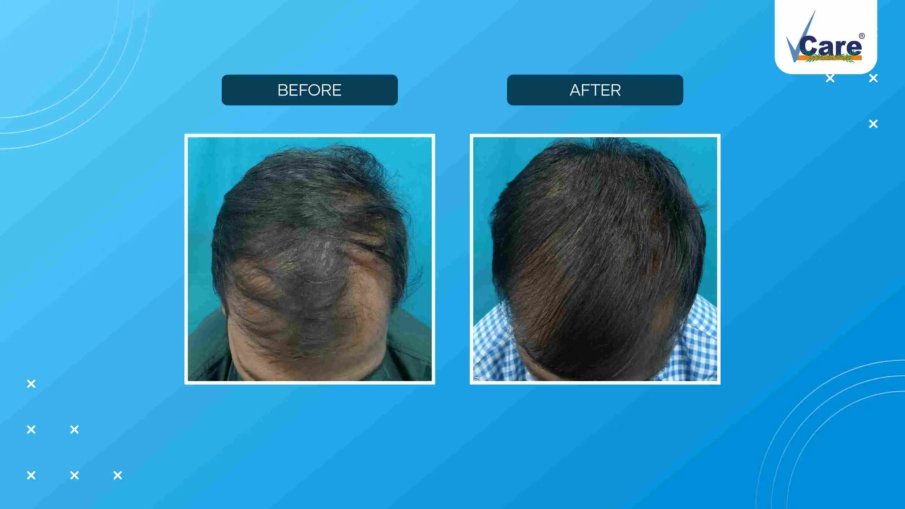 Biocell Treatment Before and After