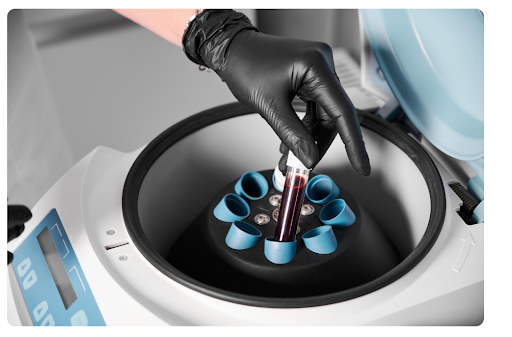 PRP Hair Treatment 