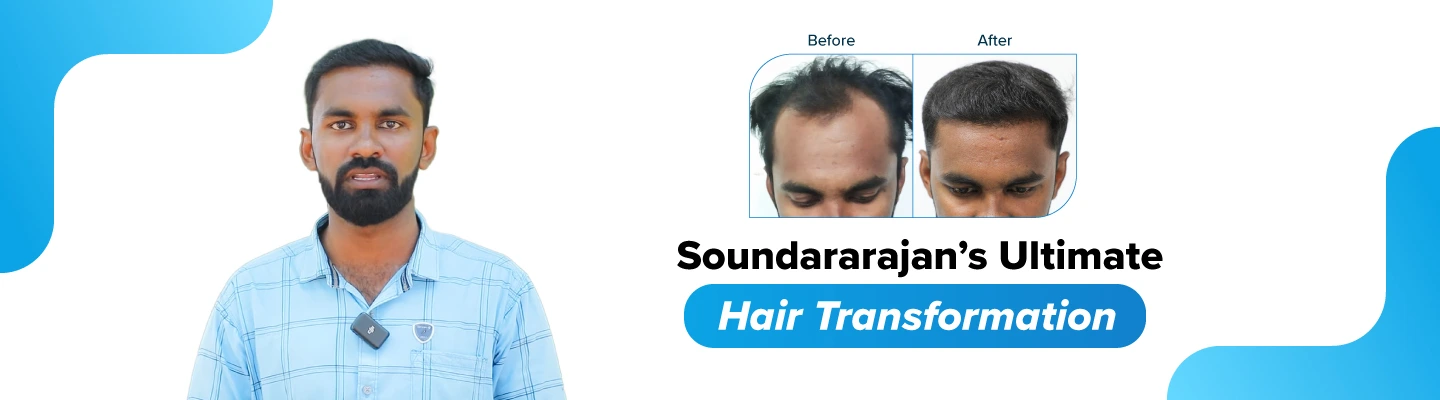 Hair Transplantation