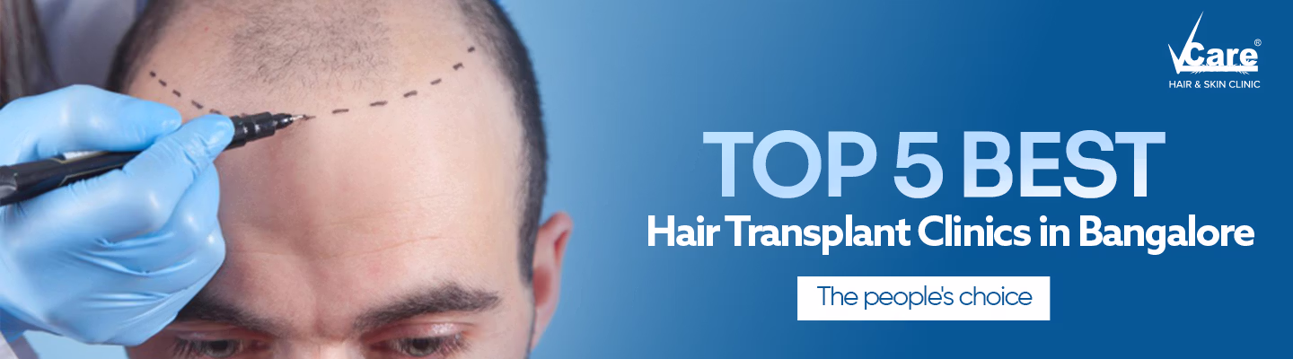 Top 5 Best Hair Transplant Clinics in Bangalore