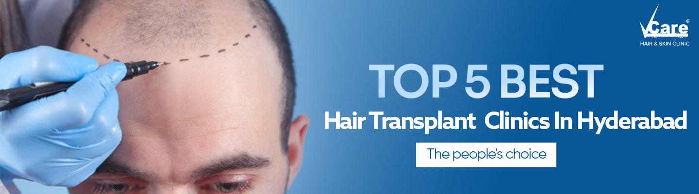 Top 5 Best Hair Transplant Clinics in Hyderabad
