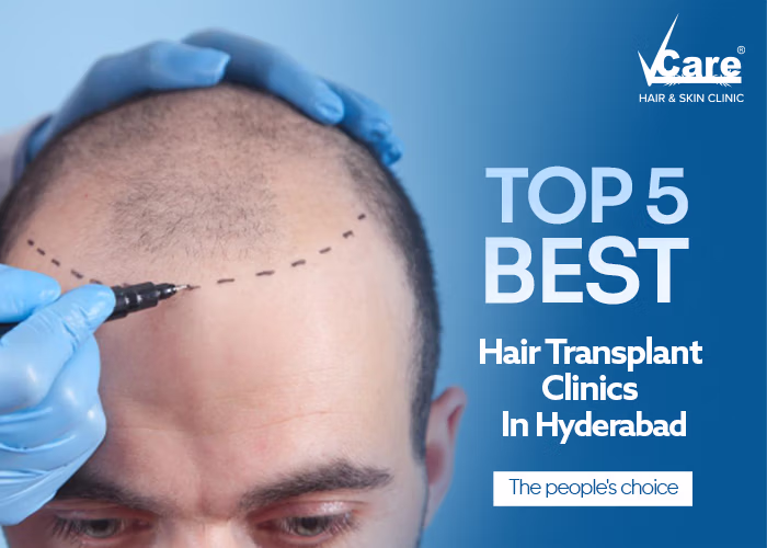 Top 5 Best Hair Transplant Clinics in Hyderabad
