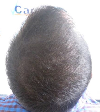 Activated Follicular Transplant Result After in VCare