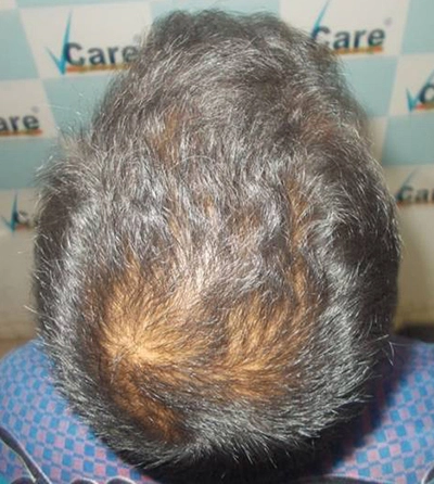 Activated Follicular Transplant Result Before in VCare