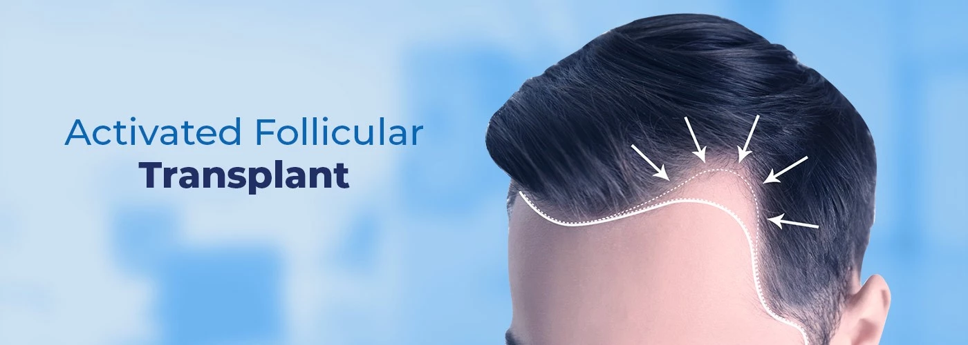 Activated Follicular Transplant | Hair Transplant Treatment - Vcare