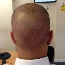 Activated Follicular Transplant Stage 03