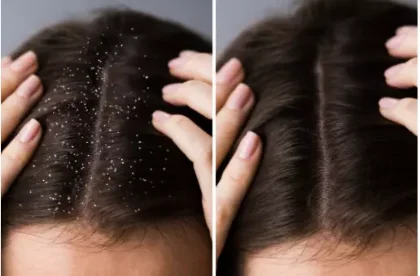 Dandruff Solution VCare