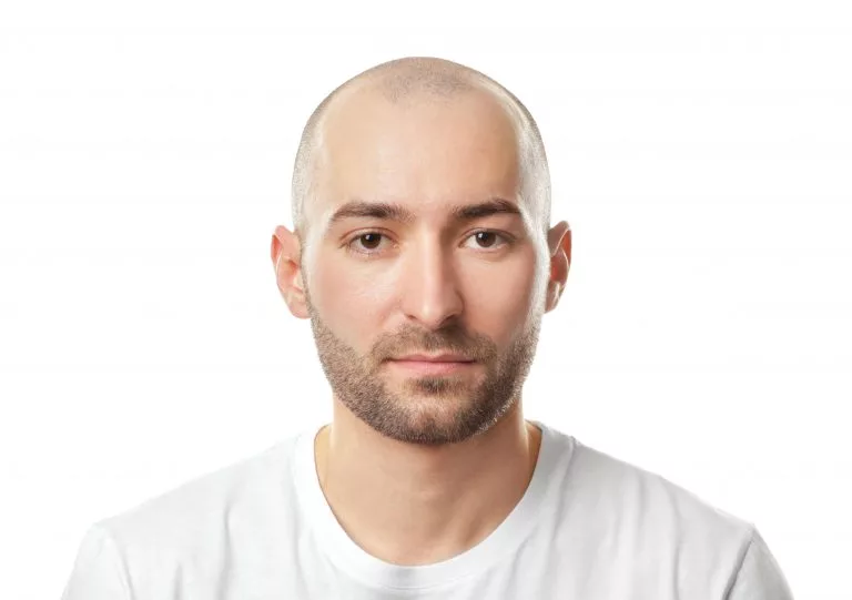 Hair Replacement in VCare Hair Replacement in Vcare
