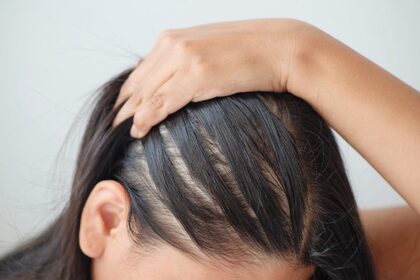 IS HAIR LOSS STRESSING YOU OUT?
Top Benefits Of Undergoing Stem Cell Therapy For Hair At VCare