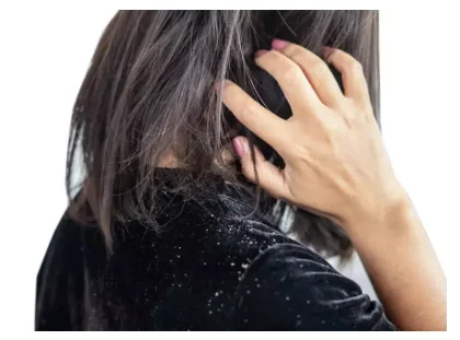 Dandruff Problem