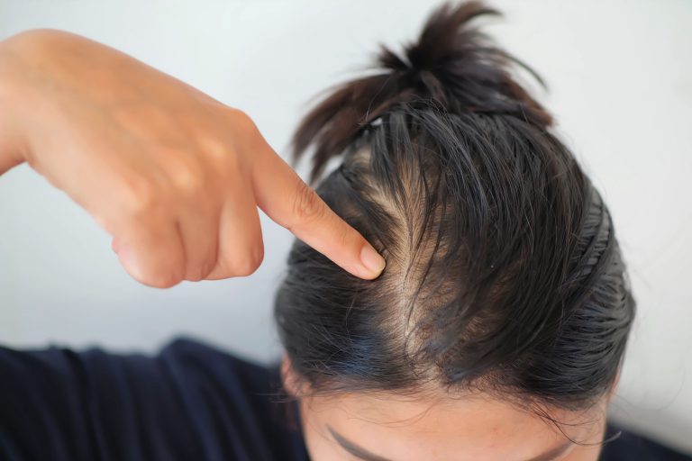 hair_fall_concern_vcare hair_fall_concern_vcare
