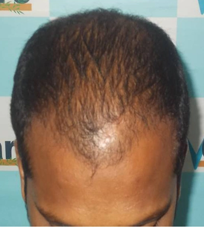 Clinical hair revive therapy before picture in VCare