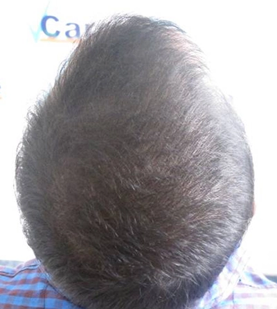 Clinical hair revive therapy after picture in VCare