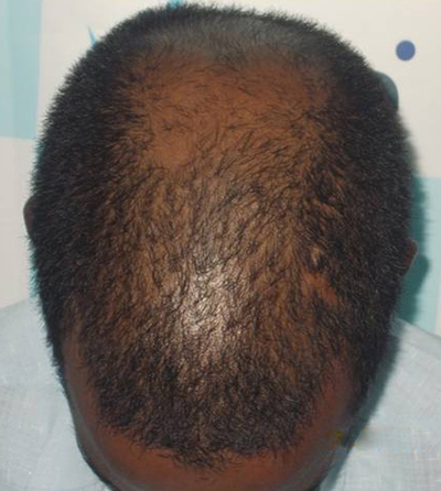 Hair Transplant in Chennai Best Surgeon Cost  Clinic