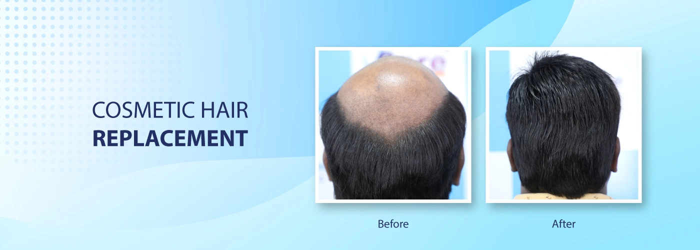 Cosmetic hair replacement - Non-surgical - VCare trichology