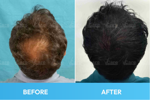Hair Loss Before