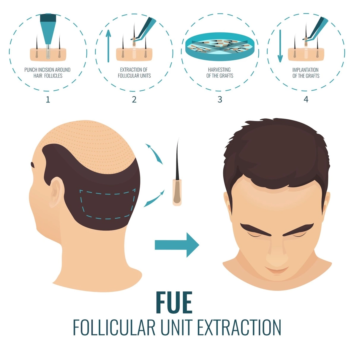 Activated Follicular Transplant