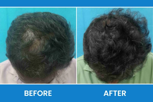 Hair Loss Before