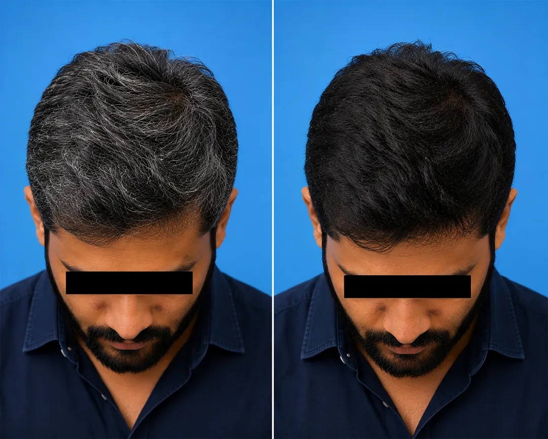 premature-grey-hair-treatment-vcare
