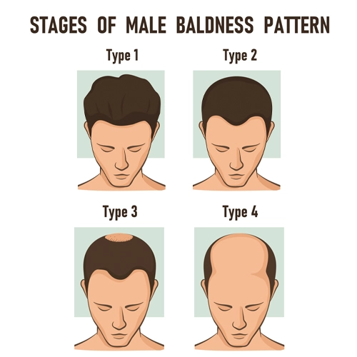 stages of male baldness pattern