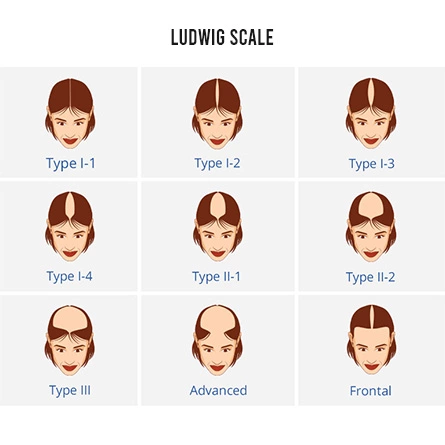 Hair loss pattern in Female