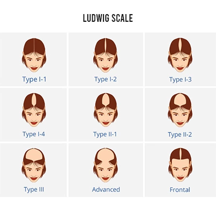 Male Pattern Hair Loss  Hair Loss In Men