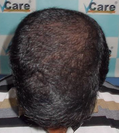 Hair rejuvation therapy after photo in VCare