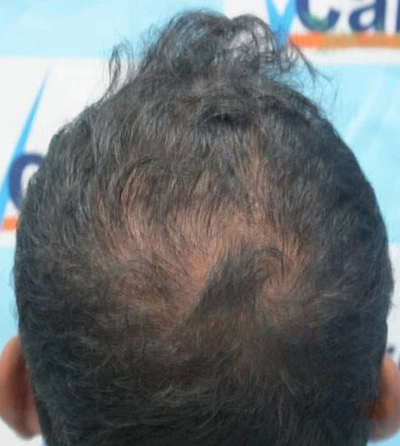 Hair rejuvation therapy before photo in VCare