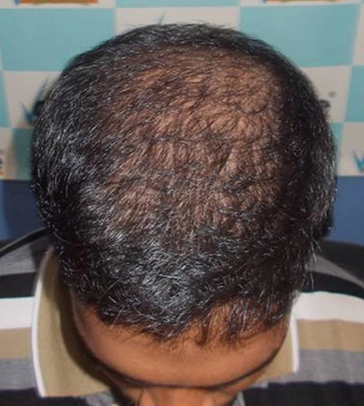 Hair rejuvation therapy before photo in VCare