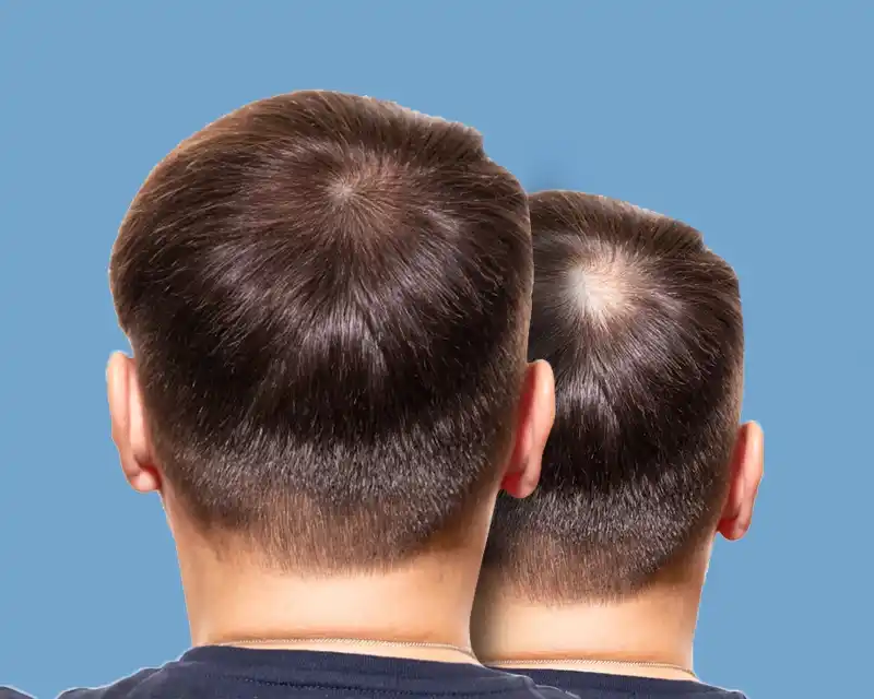 Follicular Unit Extraction Reference by VCare
