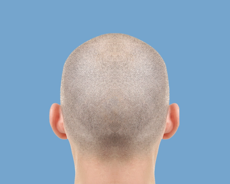 Scalp Micro Pigmentation Therapy By VCare