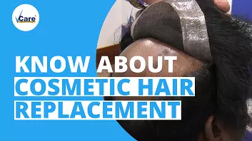 Cosmetic hair replacement in Vcare