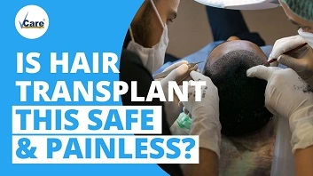 Hair transplant in Vcare