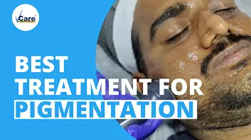 Pigmentation treatment with vcare
