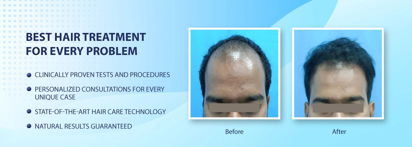 Chennai Hair Plant  Hair Transplant Clinic  YouTube